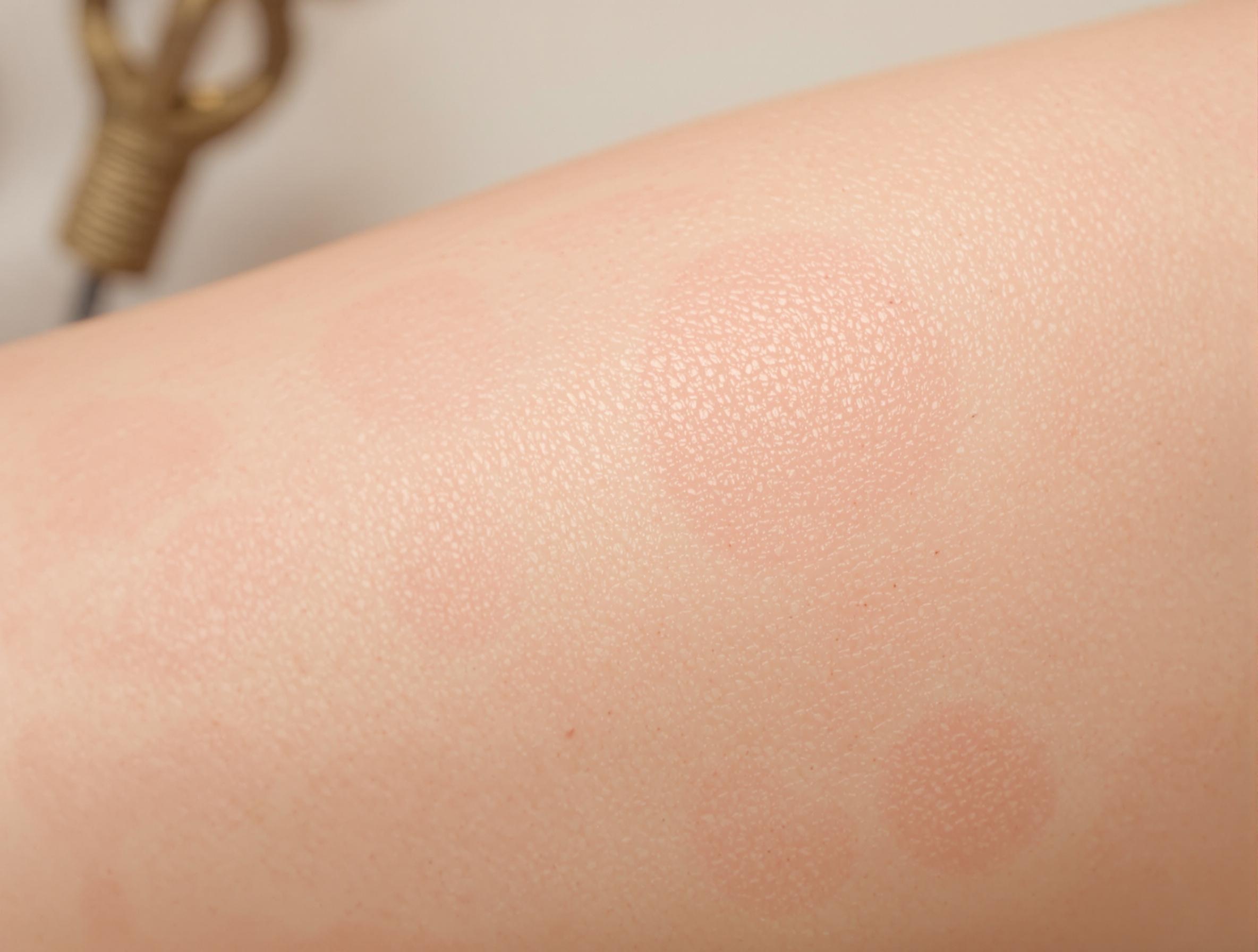 What is Toxic Mold Rash? Symptoms and Solutions Explained